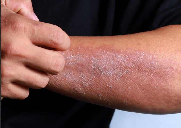Eczema Management in Daily Life